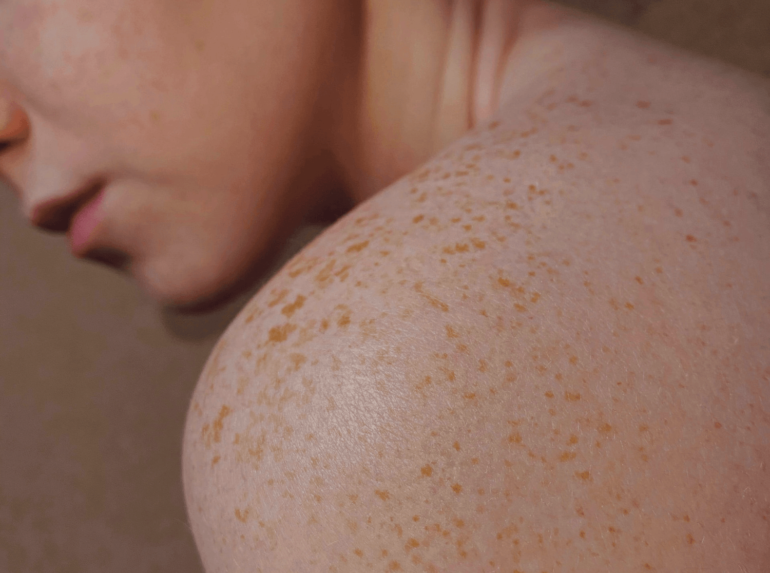 Pigmentering og ujævn hudfarve